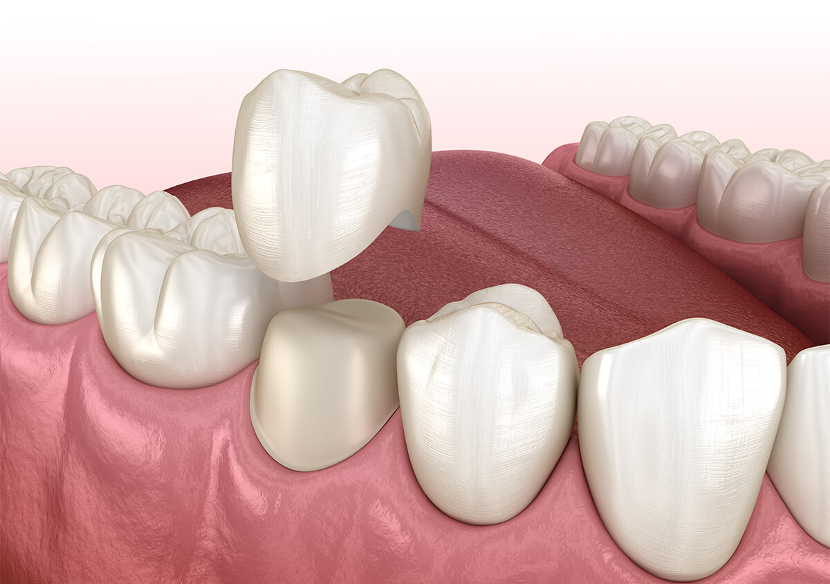 Porcelain Tooth Crown in McDonough GA Area